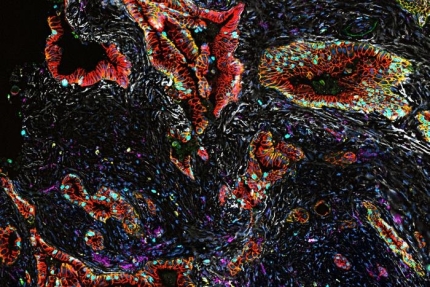 인간의 췌장암 종양. 세포핵은 청색, 세포막은 적색, 복제 중인 세포의 핵은 청록색으로 보인다. [미국 세인트루이스 워싱턴 의대 SIQI CHEN]